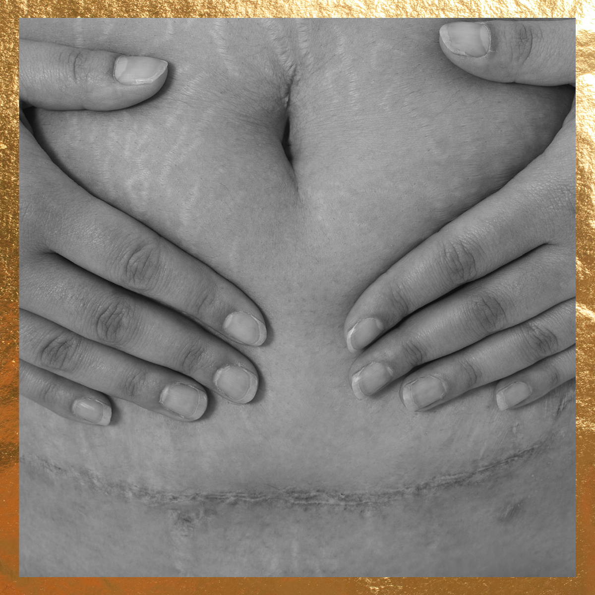 Up close of c-section scar